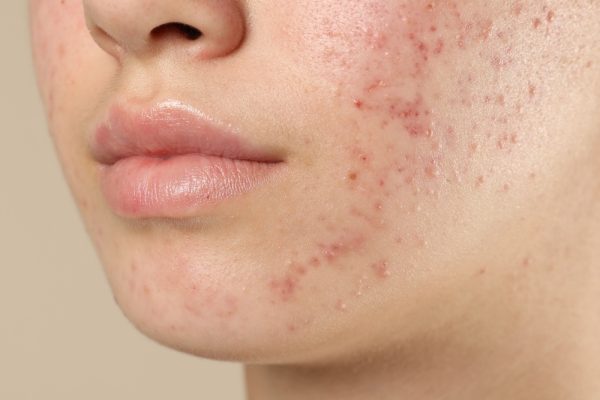 Acne: Causas, Mitos e o Caminho para uma Pele Saudável